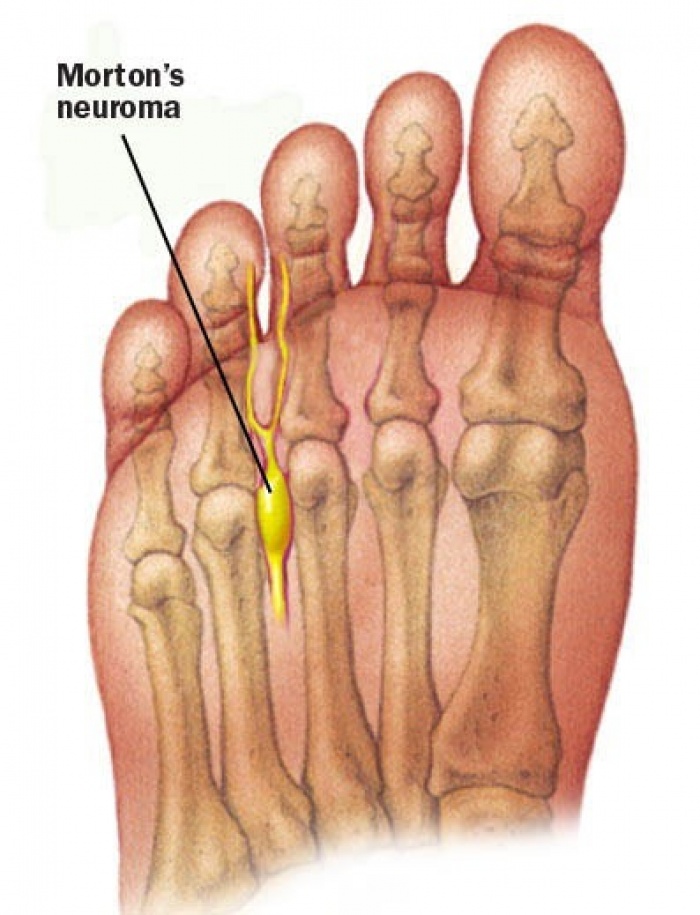 Morton's Neuroma: clinical characteristics, investigation and management.